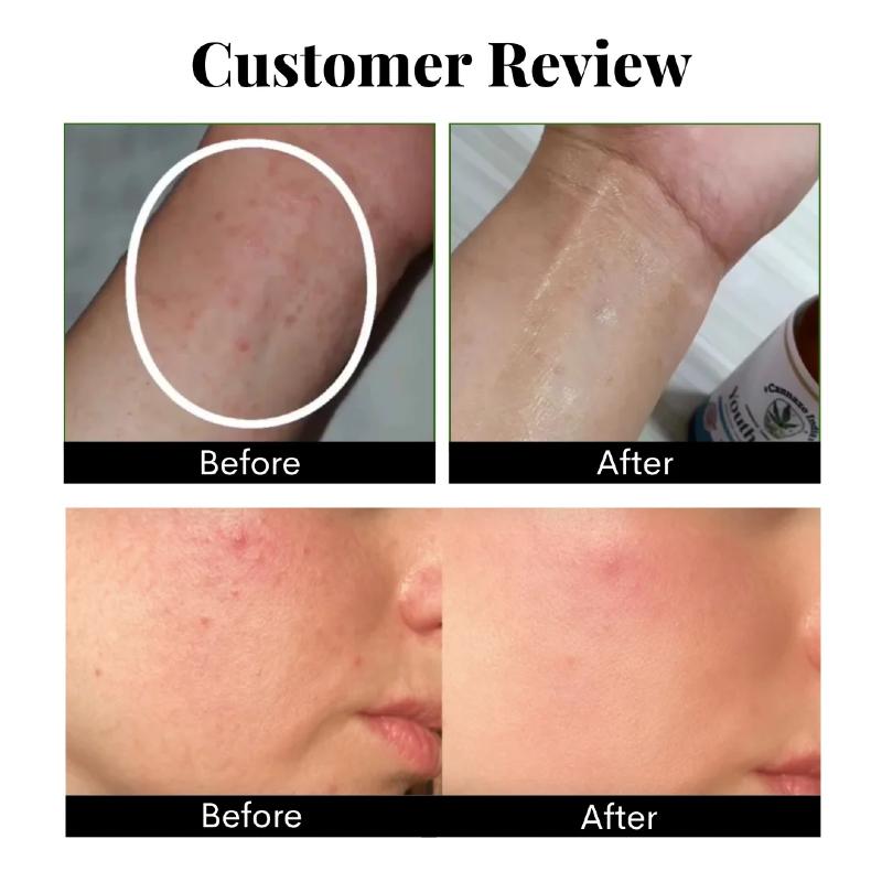 Before and after cbd skin treatment comparison with close-up of treated area.
