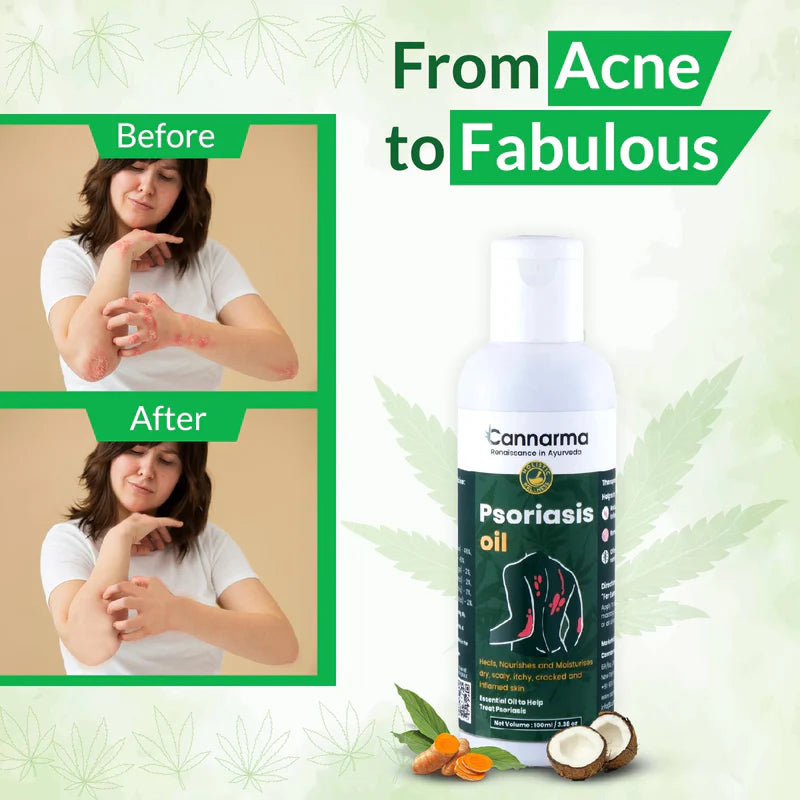 Advertisement for Cannarma Psoriasis Oil showing before and after images of a woman's clear skin after using the product.